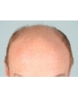 Before Hair Transplant&nbsp;2 Sessions (Areas)